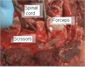 Figure 3 – Severing the attachments to free up the spinal cord.