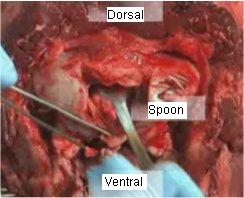 Figure 4 – Head turned – dorsal side up, advancing the collection spoon into the canal for obex removal.