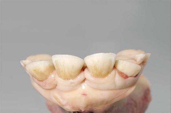 >30 months Pair of second permanent incisors in eruption