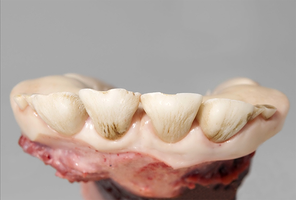 >30 months Two pairs of permanent incisors completely erupted