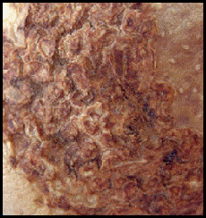 23. Severe lesions. Description follows.