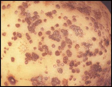 14. Development of brown raised pustules. Description follows.