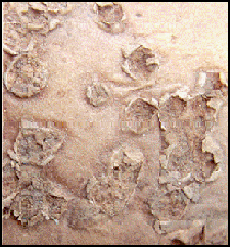 17. Ruptured pustules. Decription follows.