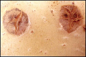 18. Initial lesions. Description follows.