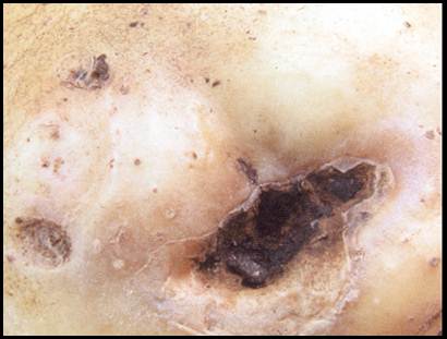 29 | Fungal threads (mycelia) surrounding lesion. Description follows.